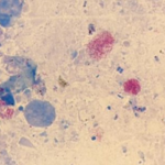 Figure One -  Coxiella Burnetii organisms seen in red under the microscope